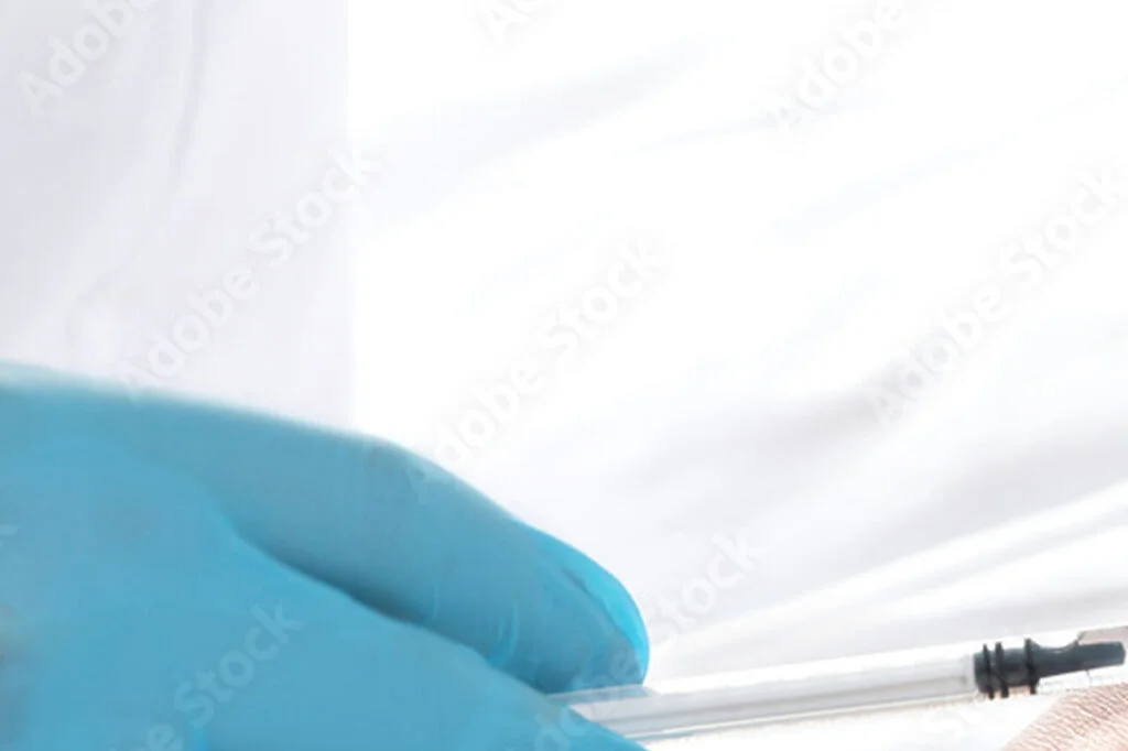 PCO Behandlung-Sklerosierung