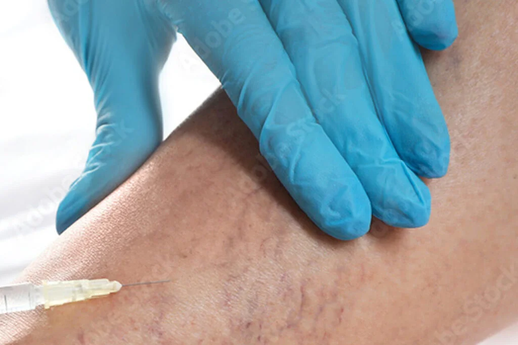 PCO Behandlung-Sklerosierung