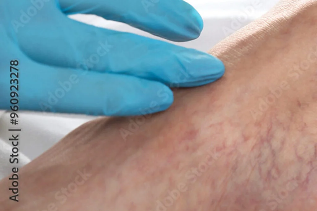 PCO Behandlung-Sklerosierung