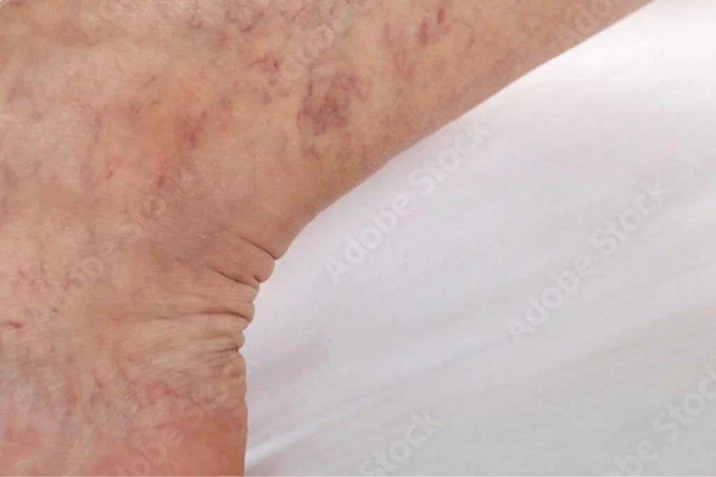 PCO Behandlung-Sklerosierung