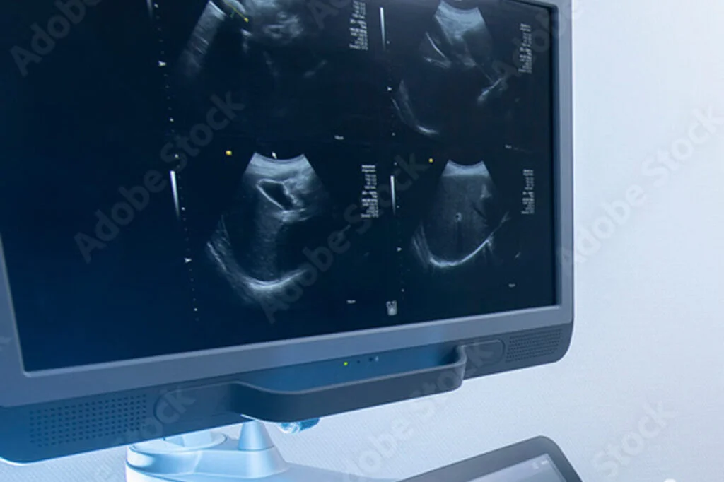 PCO Behandlung Venenstripping